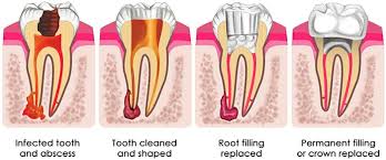 Root Canal Treatment
