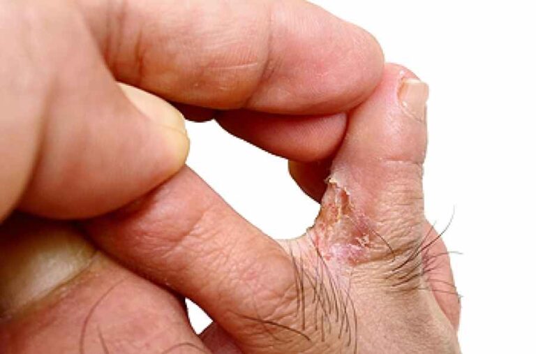 athlete’s foot and eczema