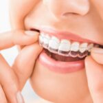 Invisalign Dubai