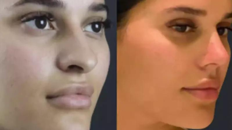 nose deviated septum surgery in dubai