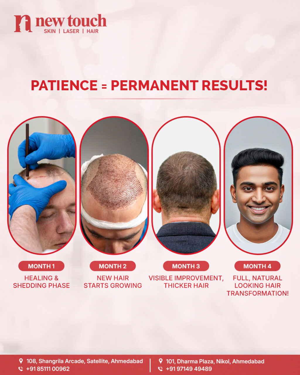 Hair Transplant Clinic in Ahmedabad