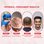 Hair Transplant Clinic in Ahmedabad