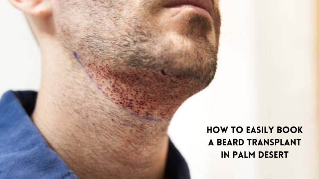 Beard transplant in Palm Desert