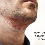 Beard transplant in Palm Desert