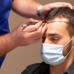 Celebrity hair transplant in Los Angeles