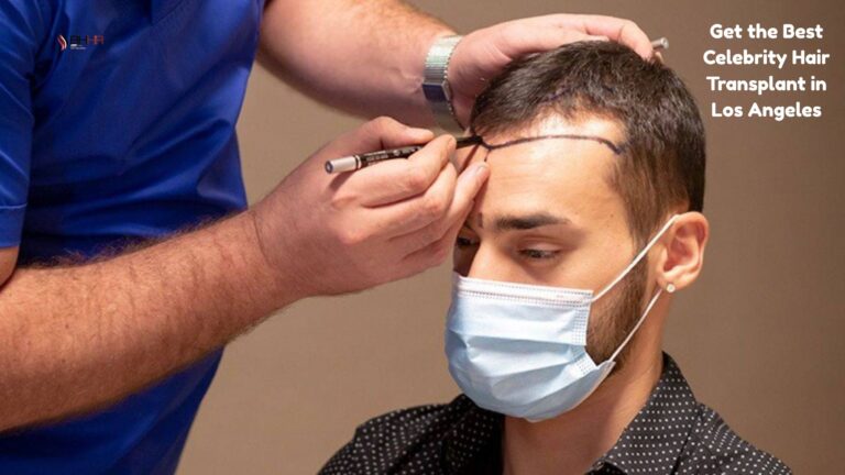 Celebrity hair transplant in Los Angeles