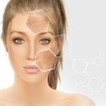 Chemical peel for Melasma