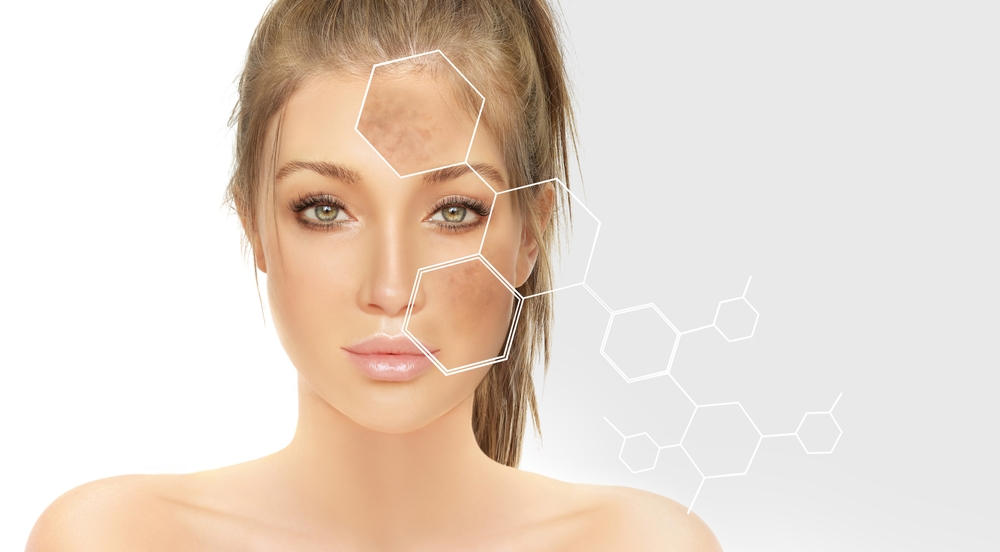 Chemical peel for Melasma