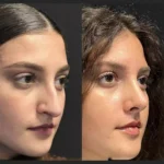 nose surgery in dubai