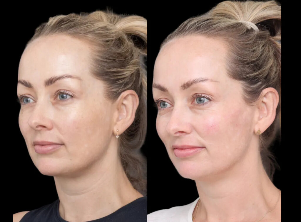 H1-Cheek-Fillers