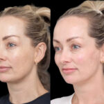 H1-Cheek-Fillers