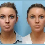 Thread Lift Treatments in Dubai: A Safe and Effective Alternative to Facelifts