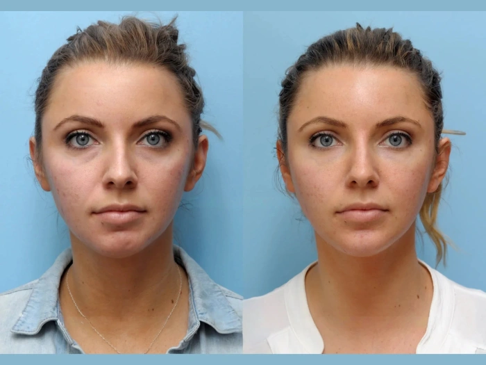Thread Lift Treatments in Dubai: A Safe and Effective Alternative to Facelifts