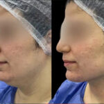 Chin Fillers in Dubai