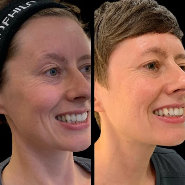 Profhilo Treatments in Dubai: Combining Profhilo with Other Aesthetic Treatments