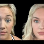 H3-Botox