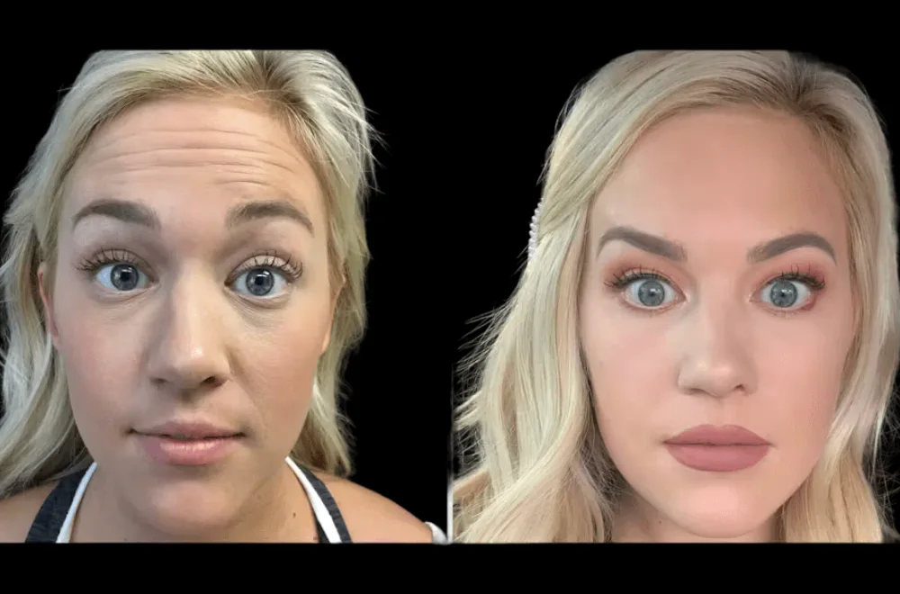H3-Botox