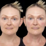 H5-Under-eye-fillers