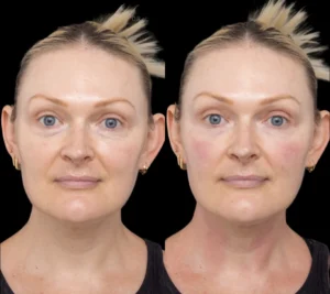 H5-Under-eye-fillers