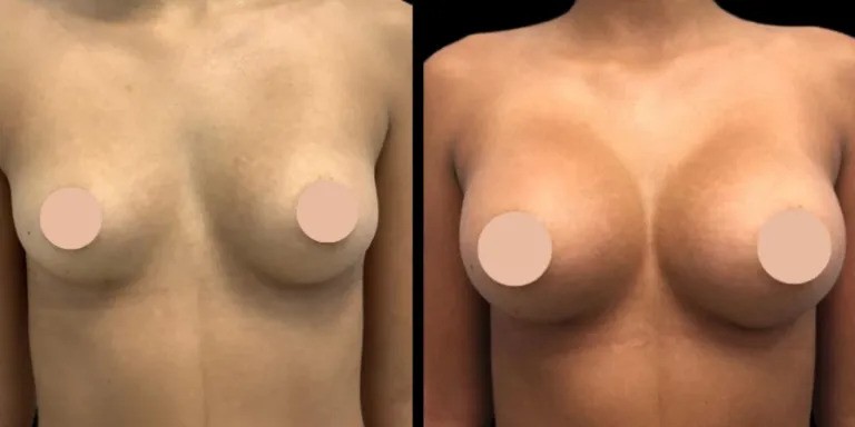 Choosing Between Fat Transfer and Implants with the Best Doctors in Dubai for Breast Augmentation