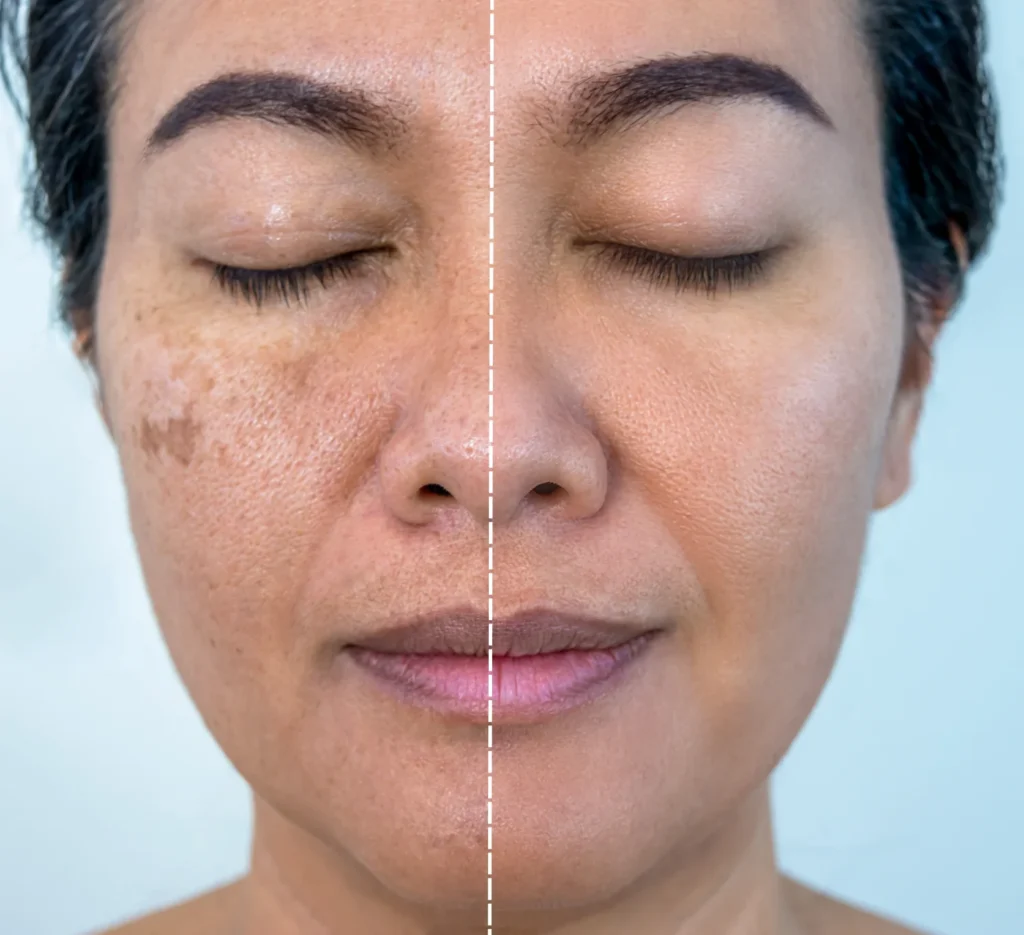 Pigmentation Treatment: Effective Solutions for Hyperpigmentation and Dark Spots