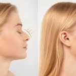 Is Rhinoplasty in Dubai the Right Choice for You? Factors to Consider