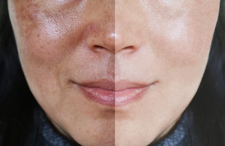 Pigmentation Treatment: How to Treat Melasma with Safe and Effective Methods
