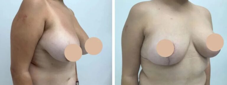 breast reduction in dubai