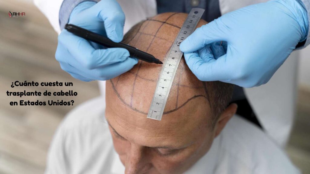 cuanto cuesta un trasplante de pelo