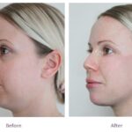 jawline fillers in dubai