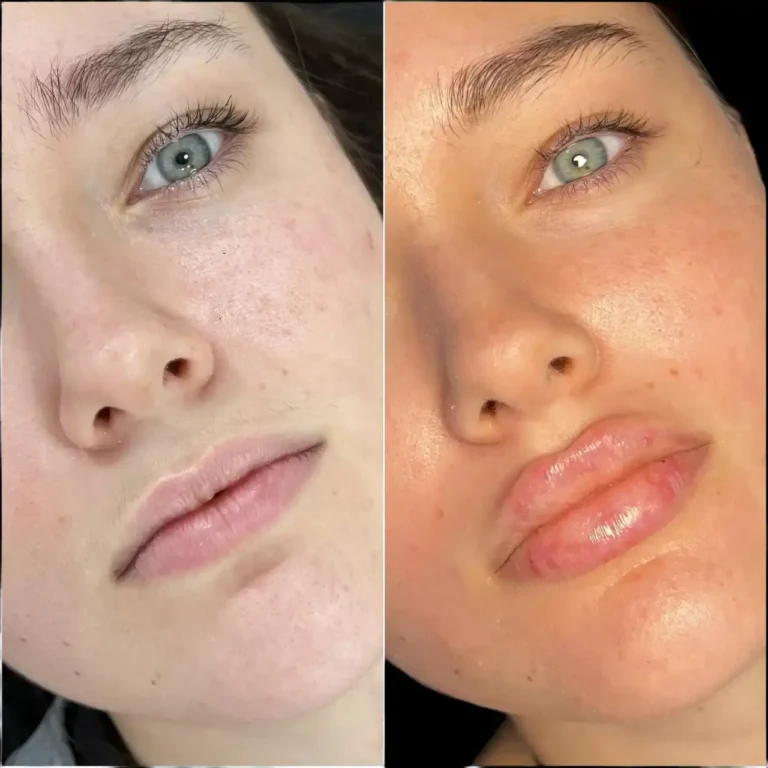 Fillers Treatments in Dubai