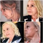 Profhilo treatment in dubai