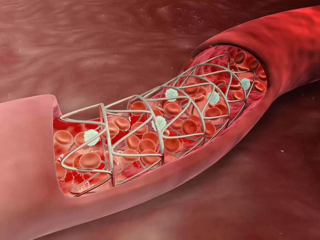 Angioplasty in Jaipur