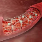 Angioplasty in Jaipur