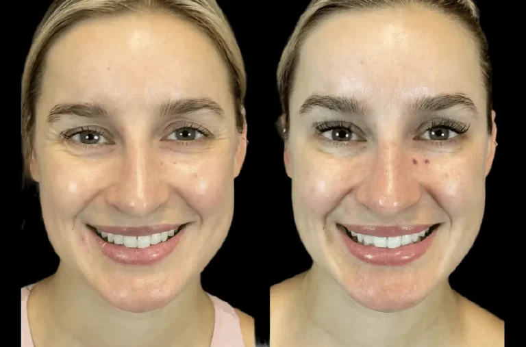 Botox in dubai