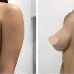 breast reduction in dubai