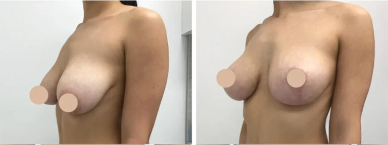 breast reduction in dubai