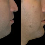 H3-Chin-Fillers