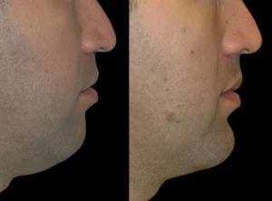 H3-Chin-Fillers