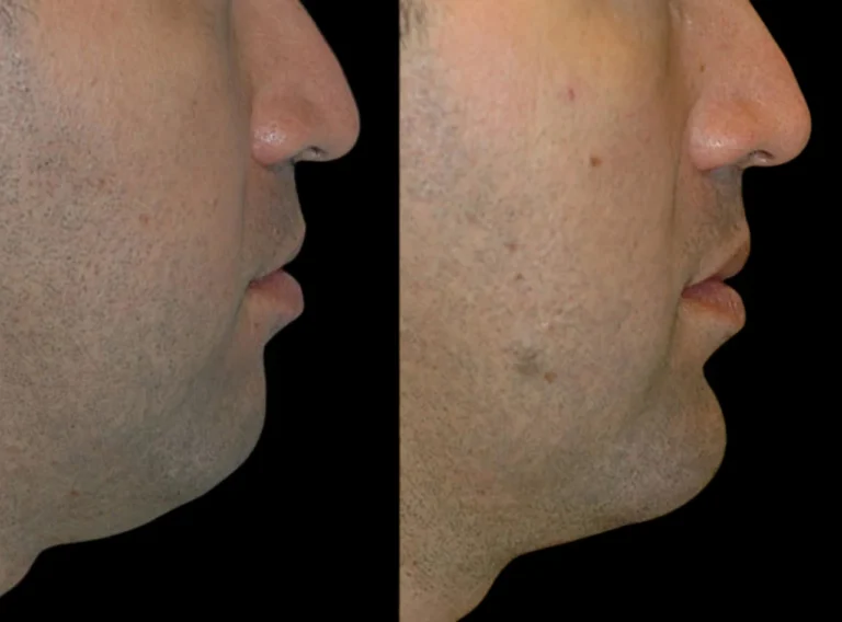 H3-Chin-Fillers