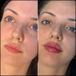 H5-lip-fillers (1) (1) (1)