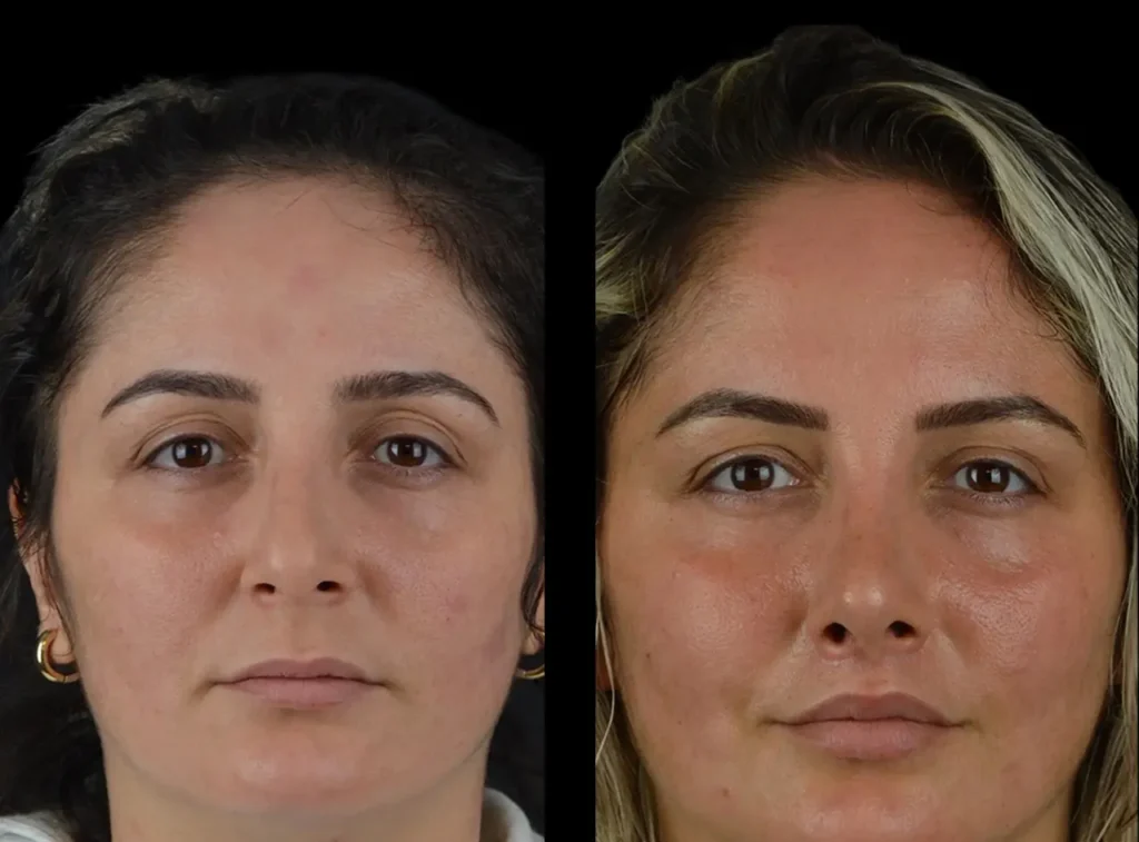 H6-Cheek-Fillers