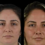 H6-Cheek-Fillers