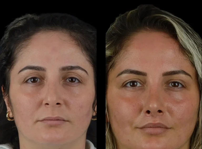 H6-Cheek-Fillers