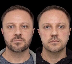 H6-Under-eye-fillers