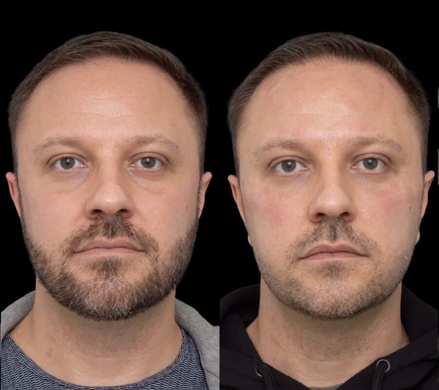 H6-Under-eye-fillers