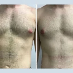 Gynecomastia Surgery in Dubai for Teenagers – What Parents Need to Know