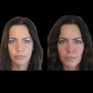 Jawline Fillers treatment in dubai
