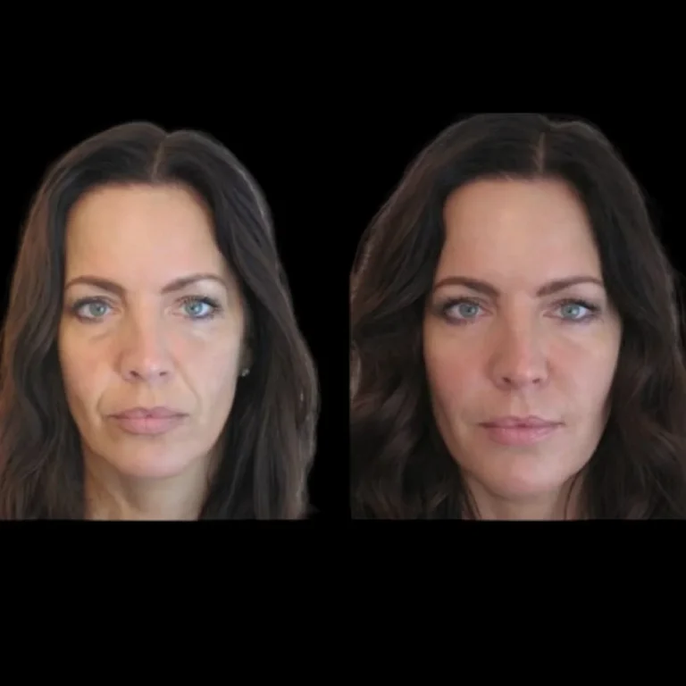 Jawline Fillers treatment in dubai