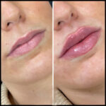 H7-Russian Lip Fillers
